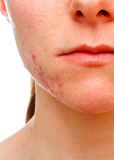 Acne