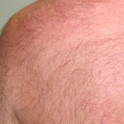 lightsheer-duet lightsheer-duet